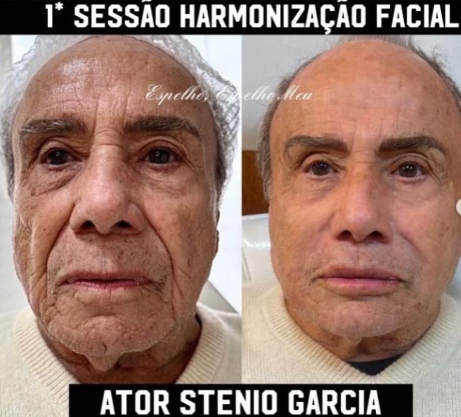 Stênio Garcia surpreende fãs ao mostrar resultado de harmonização facial; veja