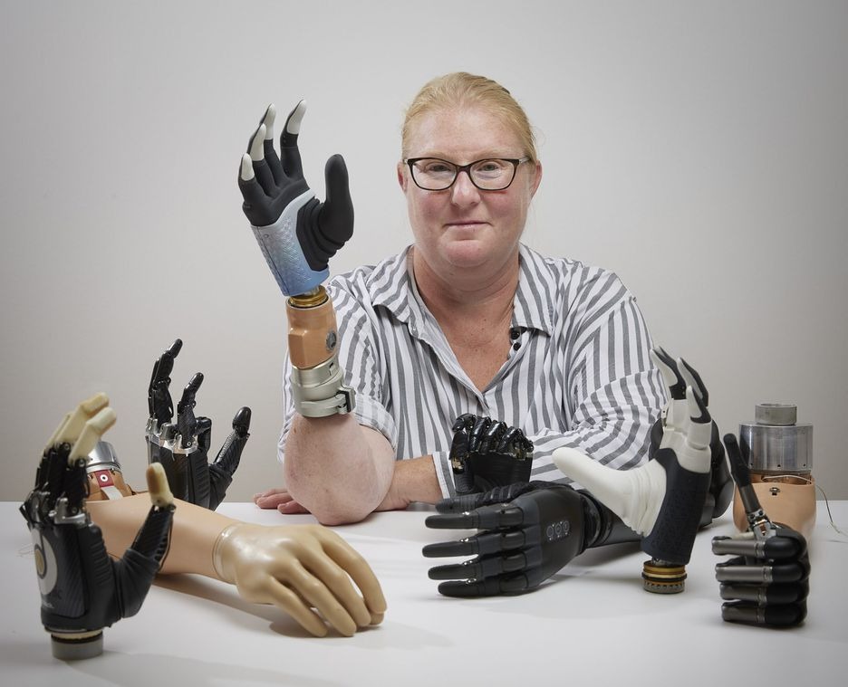 Karin, mulher de 50 anos com sua mão biônica, que se conecta aos sistemas nervoso e esquelético dela. Foto: Divulgação/Bionics Institute