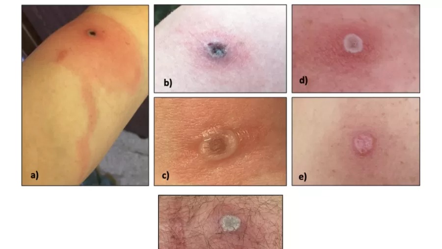 Varíola do Alaska causa lesões na pele. Foto: Departamento de Saúde do Alasca/Reprodução