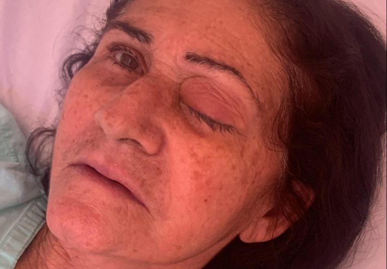 Izabel Maria, de 63 anos, perdeu a visão do olho esquerdo após passar pelo mutirão de cirurgias de catarata em parelhas. Foto: Cedida