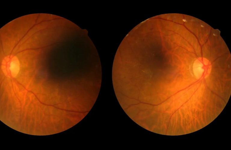 A doença ocorre quando os níveis elevados de açúcar no sangue danificam os delicados vasos sanguíneos da retina. Foto: Reprodução